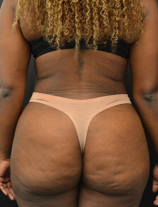 Liposuction & SmartLipo Before & After Gallery - Patient 289711 - Image 12