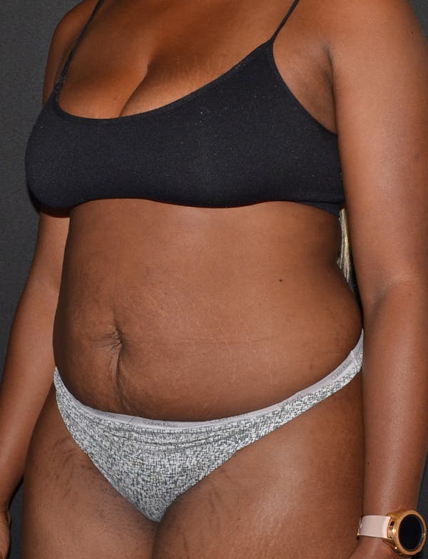 Liposuction & SmartLipo Before & After Gallery - Patient 289711 - Image 7