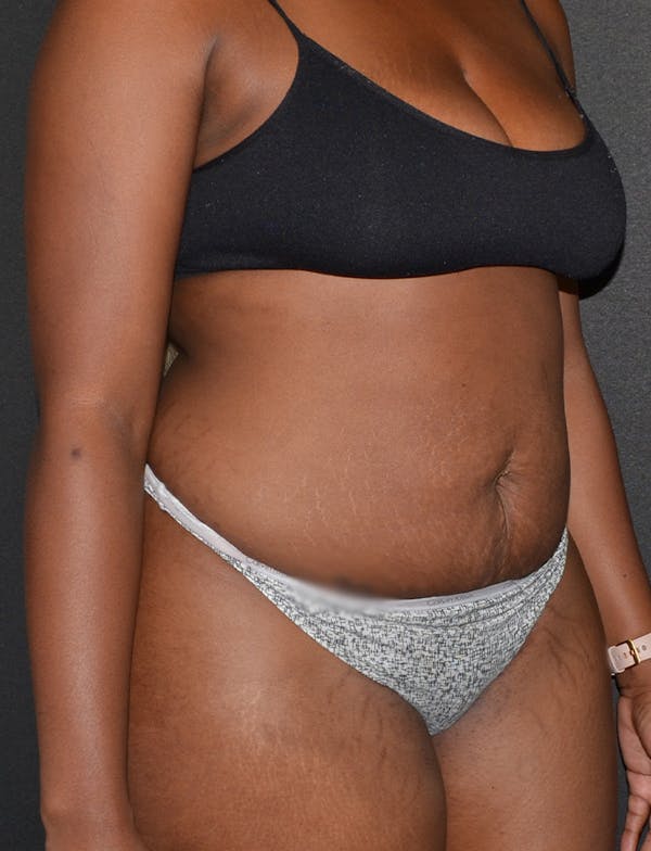 Liposuction & SmartLipo Before & After Gallery - Patient 289711 - Image 3