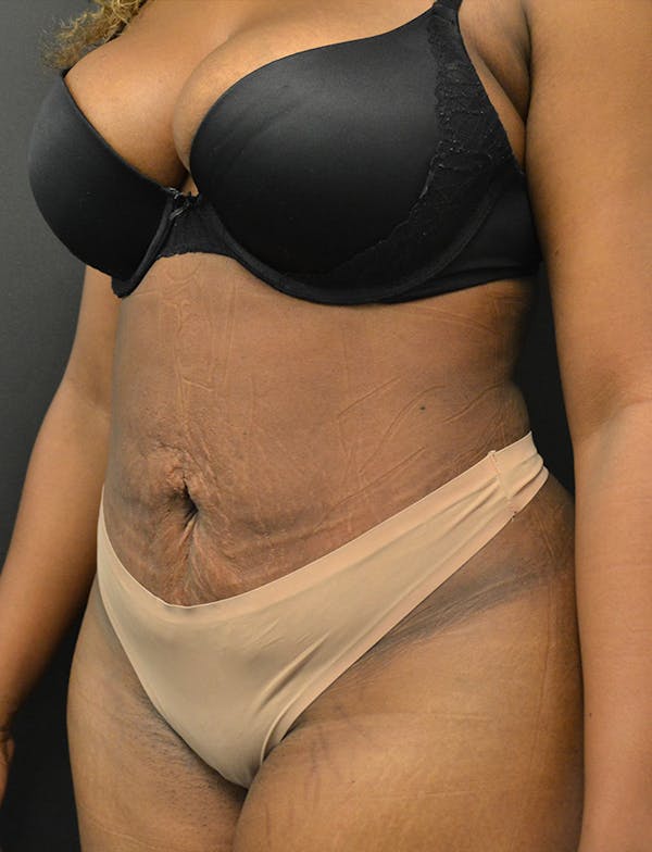 Liposuction & SmartLipo Before & After Gallery - Patient 289711 - Image 8
