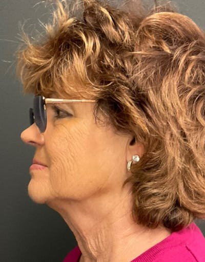 Facelift Before & After Gallery - Patient 240339 - Image 1