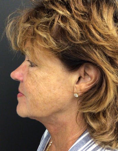 Facelift Before & After Gallery - Patient 240339 - Image 2