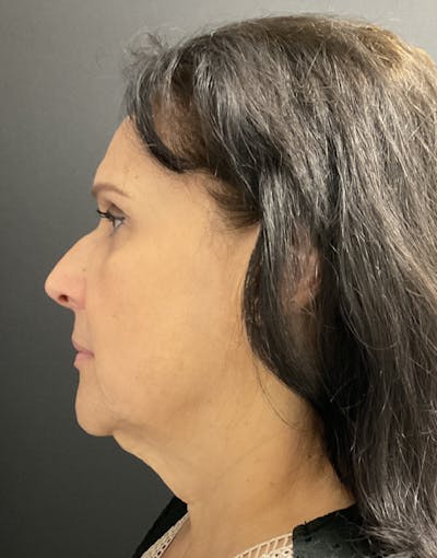 Facelift Before & After Gallery - Patient 149778 - Image 1