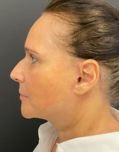 Facelift Before & After Gallery - Patient 149778 - Image 2