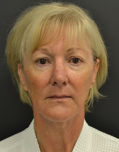 Facelift Before & After Gallery - Patient 386989 - Image 1