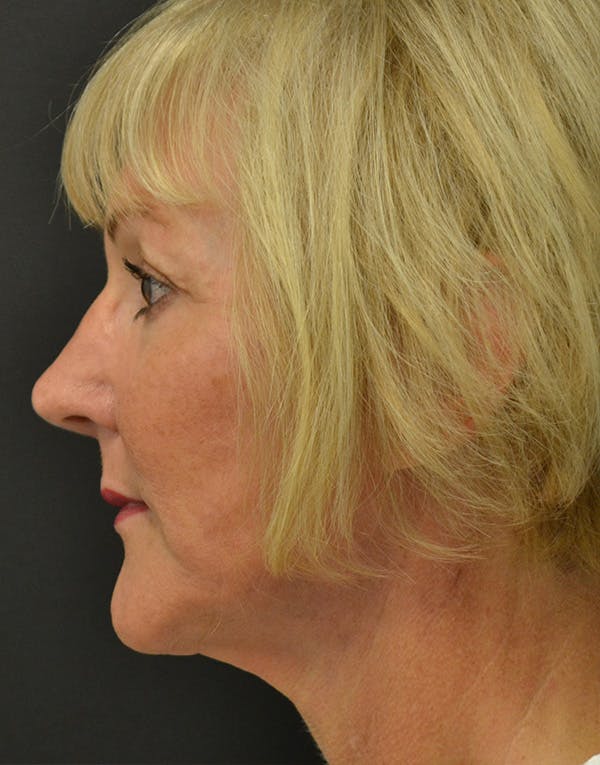 Facelift Before & After Gallery - Patient 386989 - Image 4
