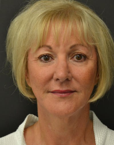 Facelift Before & After Gallery - Patient 386989 - Image 2