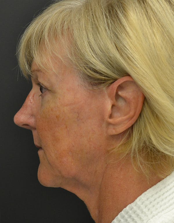 Facelift Before & After Gallery - Patient 386989 - Image 3