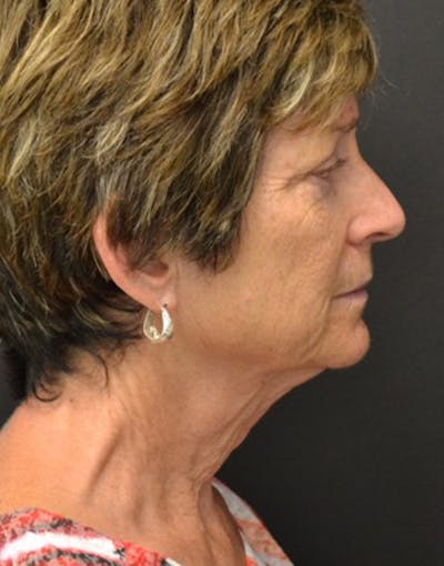 Facelift Before & After Gallery - Patient 228214 - Image 1