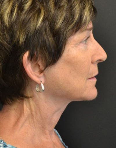 Facelift Before & After Gallery - Patient 228214 - Image 2