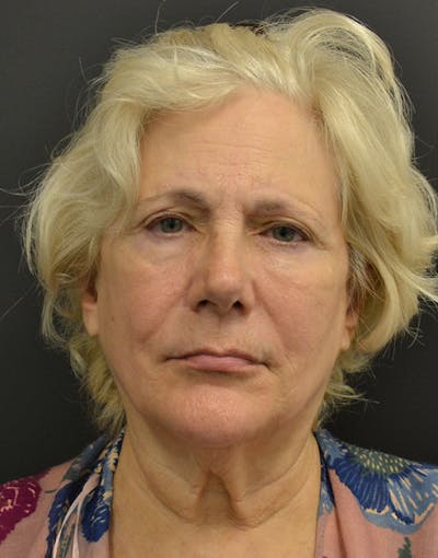 Facelift Before & After Gallery - Patient 205011 - Image 1