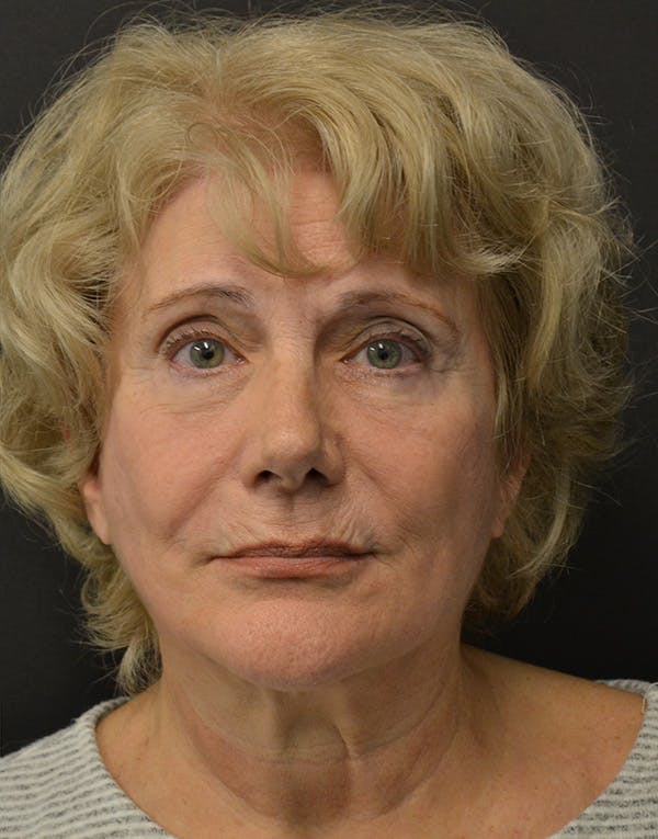 Facelift Before & After Gallery - Patient 205011 - Image 2