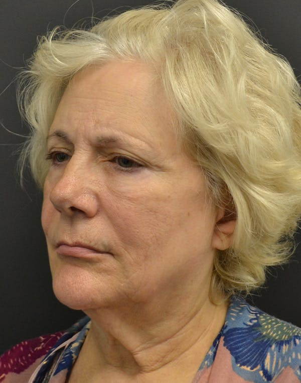 Facelift Before & After Gallery - Patient 205011 - Image 3