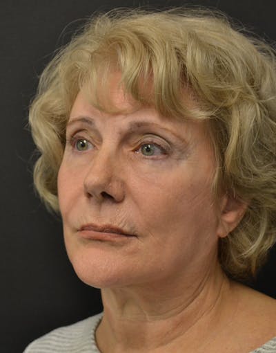 Facelift Before & After Gallery - Patient 205011 - Image 4