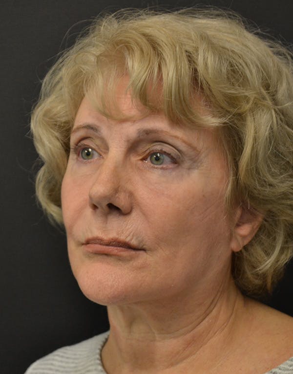 Facelift Before & After Gallery - Patient 205011 - Image 4