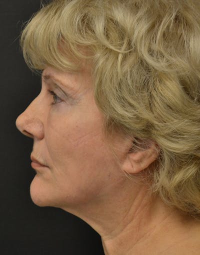 Facelift Before & After Gallery - Patient 205011 - Image 6