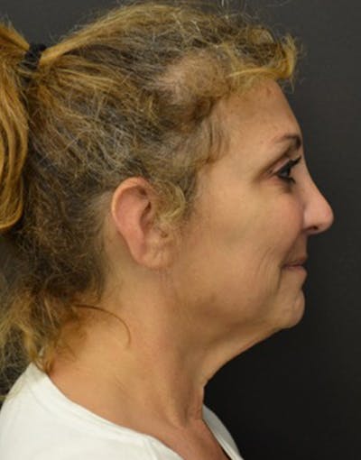 Facelift Before & After Gallery - Patient 147693 - Image 1