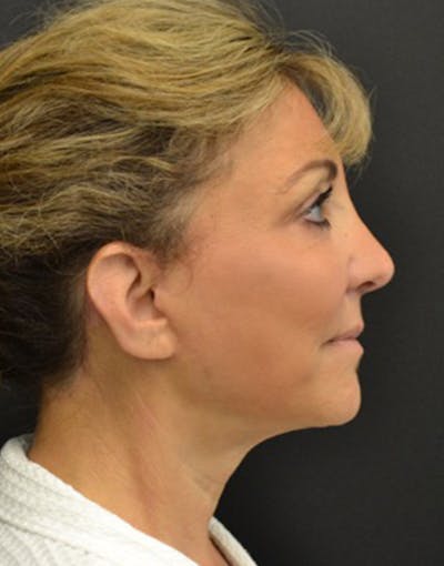 Facelift Before & After Gallery - Patient 147693 - Image 2