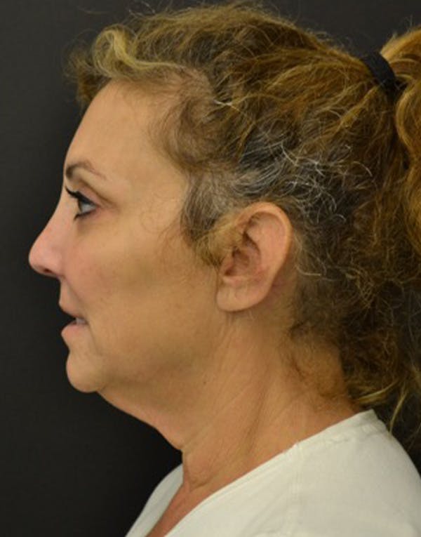Facelift Before & After Gallery - Patient 147693 - Image 3