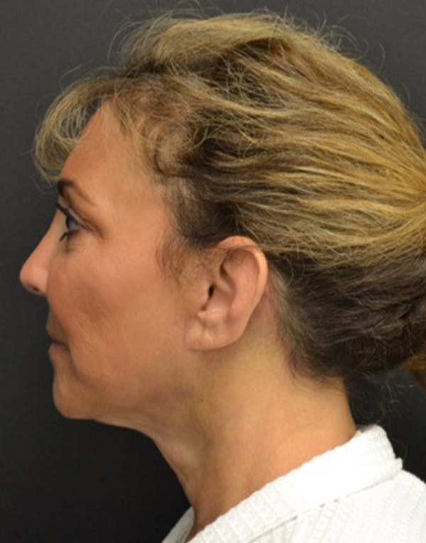 Facelift Before & After Gallery - Patient 147693 - Image 4