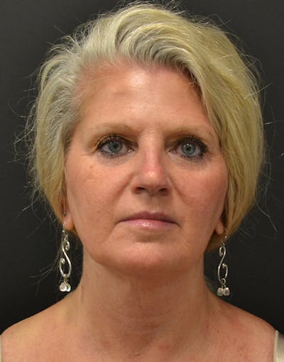 Facelift Before & After Gallery - Patient 198533 - Image 1