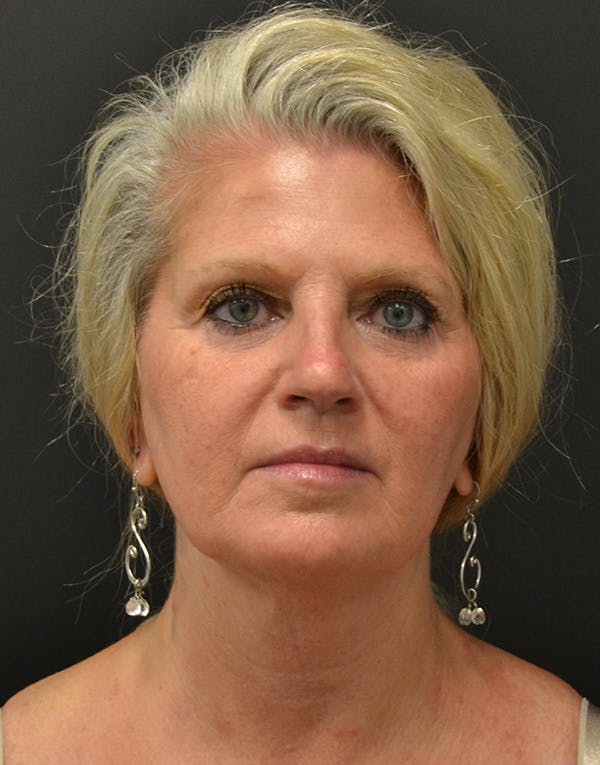 Facelift Before & After Gallery - Patient 198533 - Image 1