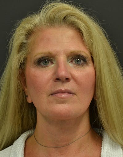 Facelift Before & After Gallery - Patient 198533 - Image 2