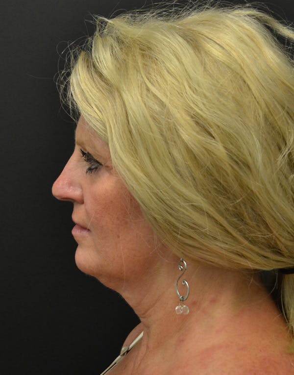 Facelift Before & After Gallery - Patient 198533 - Image 5