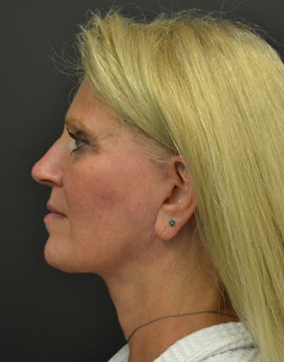 Facelift Before & After Gallery - Patient 198533 - Image 6