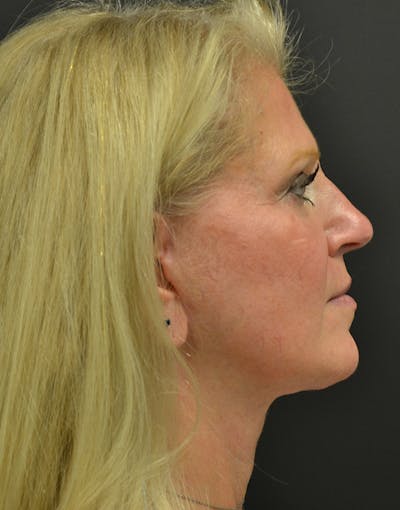 Facelift Before & After Gallery - Patient 198533 - Image 4