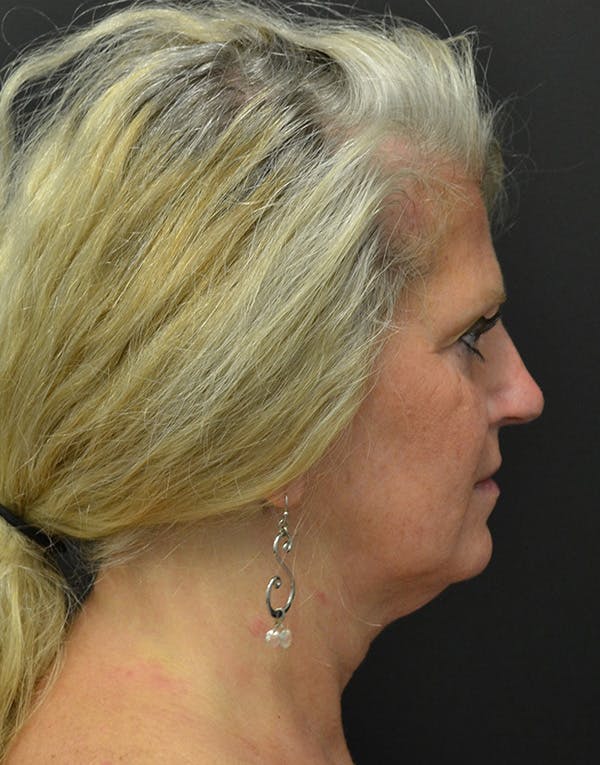 Facelift Before & After Gallery - Patient 198533 - Image 3