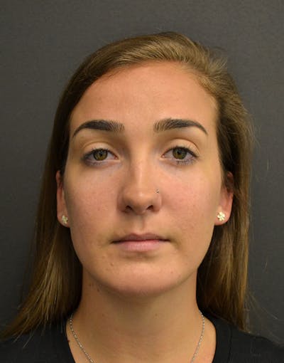 Facelift Before & After Gallery - Patient 153916 - Image 1