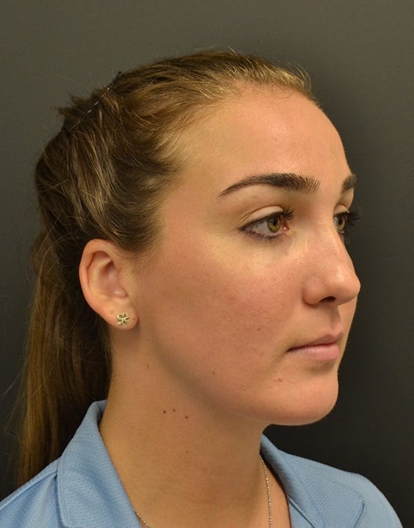 Facelift Before & After Gallery - Patient 153916 - Image 4