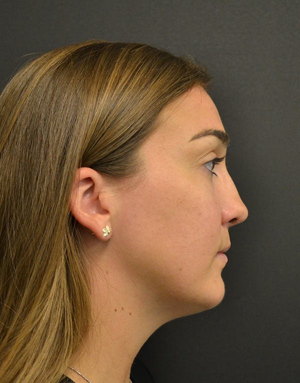 Facelift Before & After Gallery - Patient 153916 - Image 5