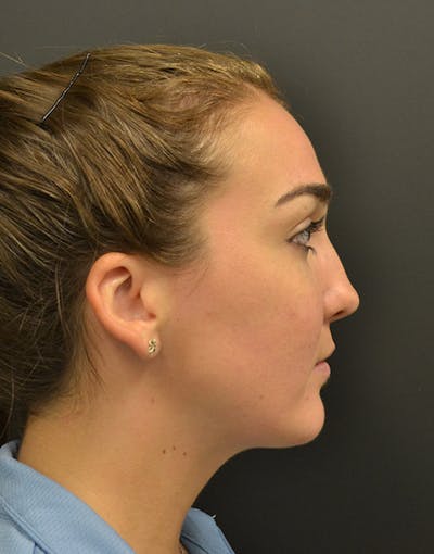Facelift Before & After Gallery - Patient 153916 - Image 6