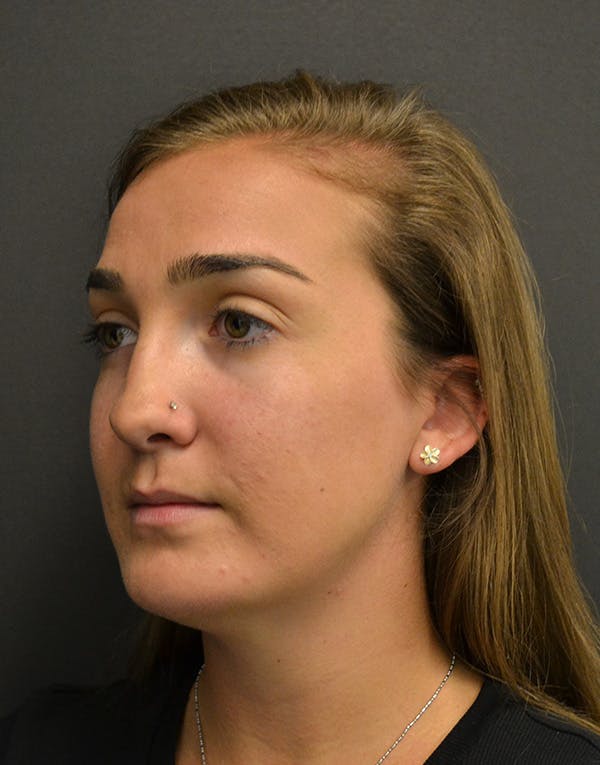 Facelift Before & After Gallery - Patient 153916 - Image 7