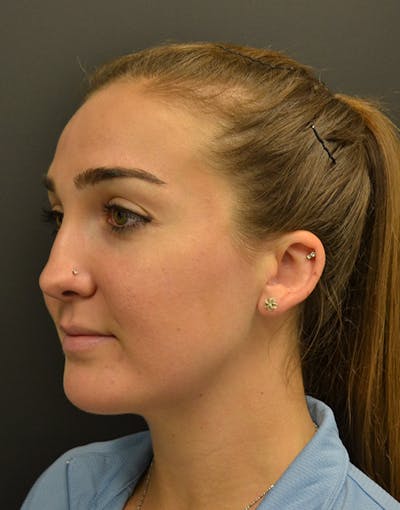 Facelift Before & After Gallery - Patient 153916 - Image 8