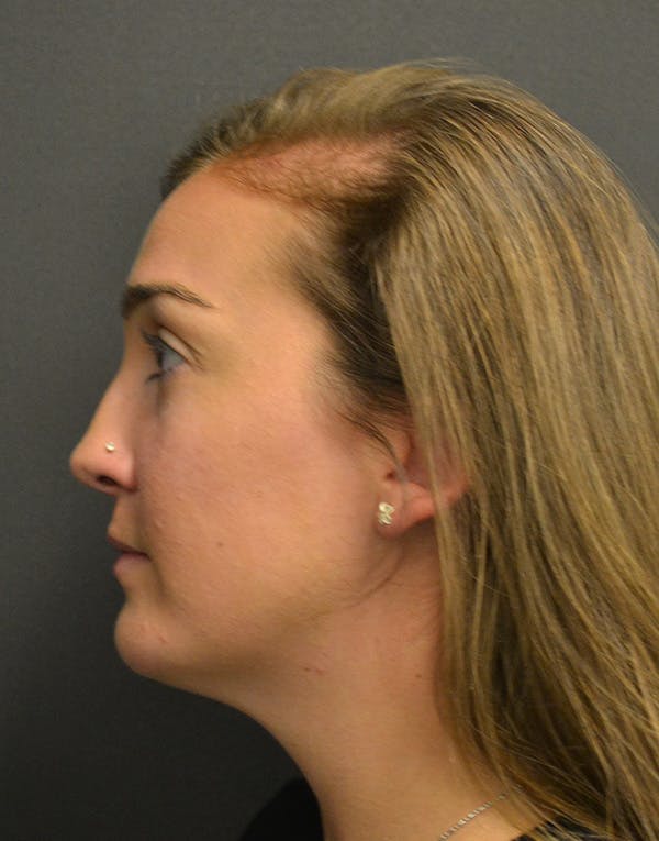 Facelift Before & After Gallery - Patient 153916 - Image 9