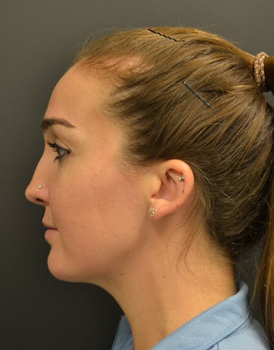 Facelift Before & After Gallery - Patient 153916 - Image 10