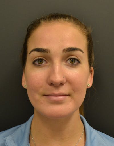Facelift Before & After Gallery - Patient 153916 - Image 2