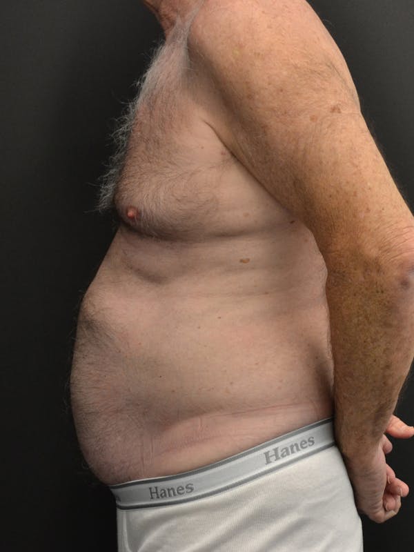 Liposuction & SmartLipo Before & After Gallery - Patient 859954 - Image 1