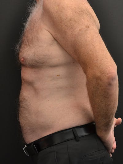 Liposuction & SmartLipo Before & After Gallery - Patient 859954 - Image 2