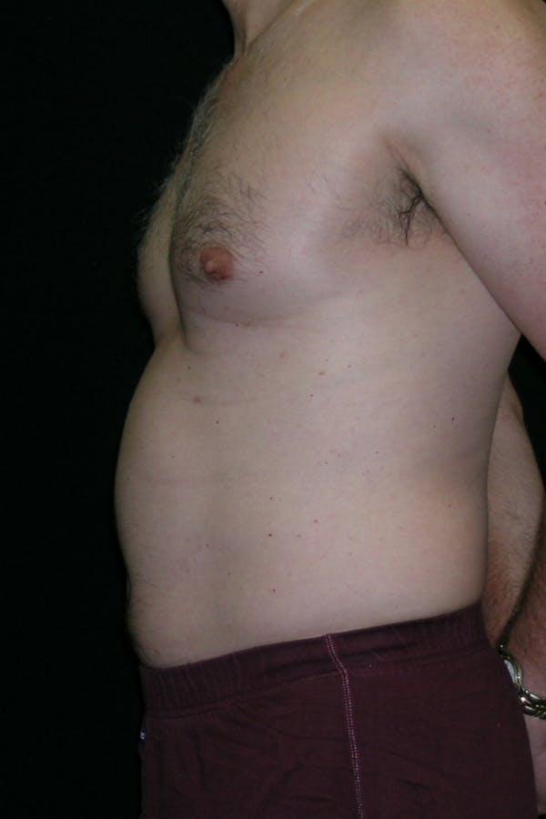 Liposuction & SmartLipo Before & After Gallery - Patient 314893 - Image 3