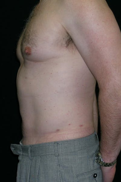 Liposuction & SmartLipo Before & After Gallery - Patient 314893 - Image 4