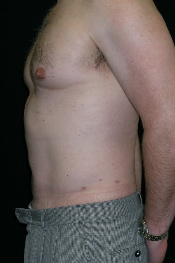 Liposuction & SmartLipo Before & After Gallery - Patient 314893 - Image 4