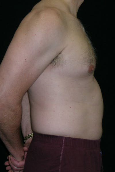 Liposuction & SmartLipo Before & After Gallery - Patient 314893 - Image 1