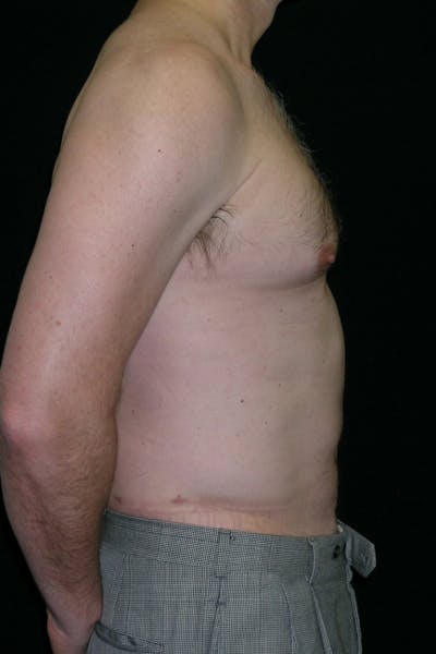 Liposuction & SmartLipo Before & After Gallery - Patient 314893 - Image 2