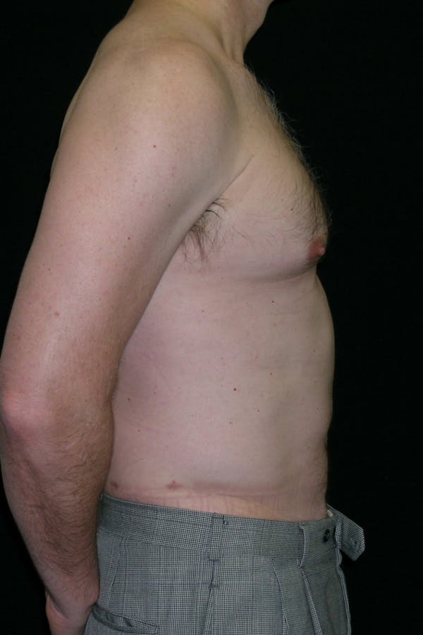 Liposuction & SmartLipo Before & After Gallery - Patient 314893 - Image 2