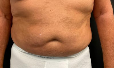 Liposuction & SmartLipo Before & After Gallery - Patient 306947 - Image 1