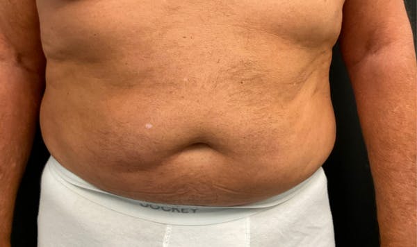 Liposuction & SmartLipo Before & After Gallery - Patient 306947 - Image 1